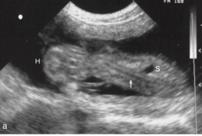 การวินิจฉัยการตั้งครรภ์ด้วยการอัลตราซาวน์